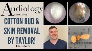 COTTON BUD & SKIN REMOVAL BY TAYLOR - EP626