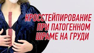  КРОССТЕЙПИРОВАНИЕ ПАТОГЕННОГО ШРАМА НА ГРУДНОЙ КЛЕТКЕ | Валентин Гайт | Учебный центр BBALANCE