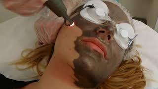 Hollywood Laser Peel Treatment in Dubai @Euromed® Clinic Dubai #lasercarbonpeel #hollywoodpeellaser