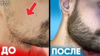 Не росла борода НА ЩЕКАХ / Результаты 15% ксиноксина