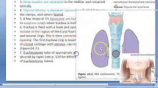 ENT Tracheostomy technique steps