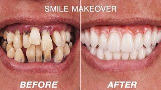 Before & After Smile Makeover Transformations | Cosmetic Dentistry Dental Boutique