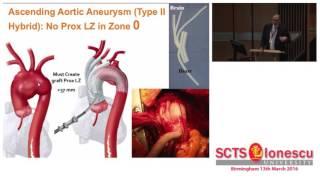 Hybrid Repairs of Arch Aneurysms