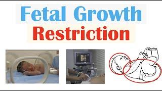 Fetal Growth Restriction (FGR, IUGR) | Types, Causes, TORCH Infections, Diagnosis, Treatment