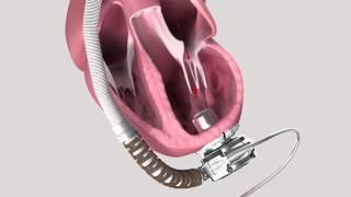 AXS Studio cardiothoracic surgery vad medical device animation