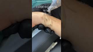 Tattoo removal with Pure Cell NLS #medspa #laser #tattooremoval