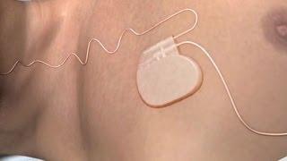 New sleep apnea device gets FDA approval