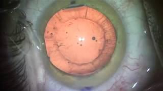 Efficient cortical cleanup during cataract surgery. Shannon Wong, MD 1-26-19