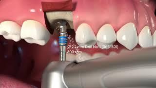 Protocole de pose de l’implant Straumann® TLX