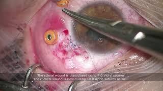 Intraocular foreign body extraction, Tips & Tricks | Dr Sami A. Saad featuring Dr B. Blautain