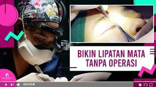 CARA MEMBUAT LIPATAN MATA PERMANEN TANPA OPERASI | Beautylogica Clinic