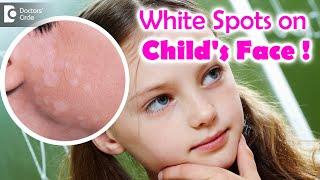 5 Things to know if your child is suffering from Pityriasis Alba? - Dr. Divya Sharma|Doctors' Circle