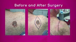 Surgery for Melanoma