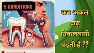 5 Conditions of wisdom tooth removal..कब अकल दाढ़ निकलवाना पड़ेगा?