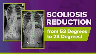 Scoliosis Reduction from 53 Degrees to 23 Degrees: Ronica's Story