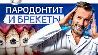 Брекеты при пародонтите. Все нюансы простыми словами за 13 минут