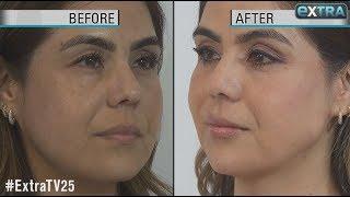 How to Get a Quick Face-Lift Without Surgery