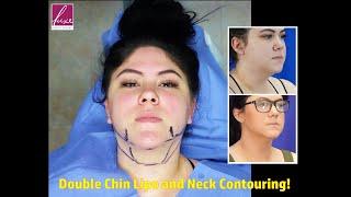 Double Chin Liposuction with Neck Contouring! Wide Awake, Local Anesthesia, In-Office and QUICK!