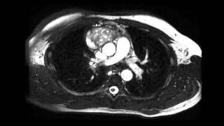 Thymoma