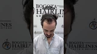 6 months hair transplant update #hairtransplant #bogotahairlines #transplantecapilar