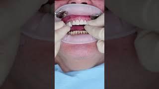 Dental veneers in Prague #shorts #dentist #dental #veneers #short