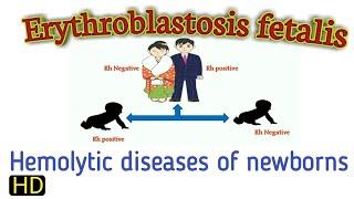 What is hemolytic diseases in newborns baby HDN || erythroblastosis fetalis in Hindi ||