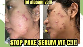 INI ALASAN AKU BERHENTI PAKE SERUM VITAMIN C ||| JIGLYCIOUSS SKINCARE