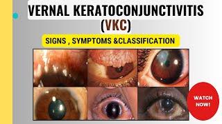 Vernal Keratoconjunctivitis (VKC) | Clinical features, Pathophysiology, and Grading