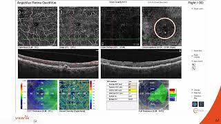 Using the Optovue Solix and VX130+ to fit Scleral Lenses with Drs. Mile Brujic and Jeffrey Sonsino