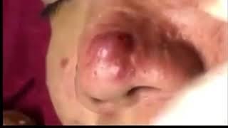 Big Infected Cystic Acne Removal On Nose!! Please