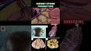 Kidney Stone formation Animation | Kidney stone removal | Kidney disease