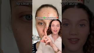 CLEAR ACNE- HOW⁉️#acne #clearskin #acnetips #skincaretips #skincare #cloggedpores #skincaremistakes