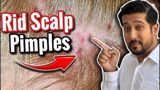 Scalp Pimples Removal | 5 Fast and Easy Ways to Get Rid of Scalp Pimples