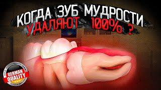 В этих случаях зуб мудрости удаляется 100%