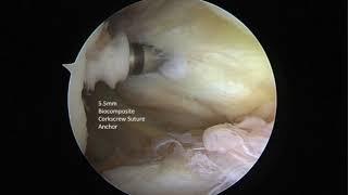 Arthroscopic Double-Pulley Remplissage Using a 2-Portal Technique for Hill-Sachs Lesions...