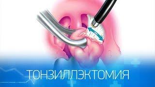 Лазерное удаление небных миндалин – что это такое?