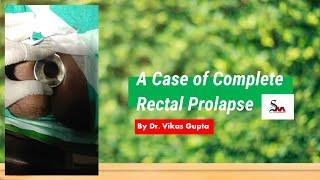 A case of complete Rectal Prolapse By Dr. Vikas Gupta From Sandhya Raman Adhar Foundation