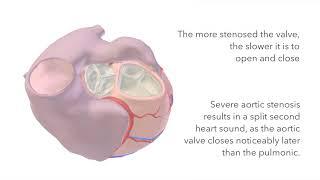 Aortic Stenosis - Murmur Sound & Animation