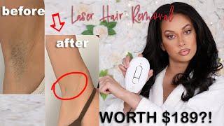 I tried IPL Laser Hair Removal! Is it worth it??? RoseSkinCo Lumi Results