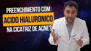 Quando e como usar preenchimento com acido hialuronico na cicatriz de acne?