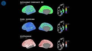 Amyloid accumulation in genetic forms of Alzheimer’s disease | The Lancet Neurology