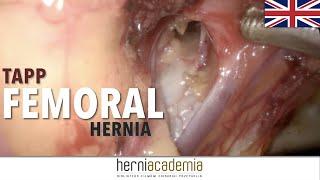 Femoral hernia in TAPP repair - full recording with commentary