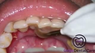 Cleaning Calculus with ultrasonic : Scaling Lower Teeth...