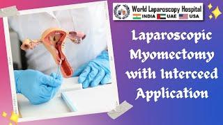 Laparoscopic Myomectomy for small multiple fibroid & application of Interceed to prevent adhesion