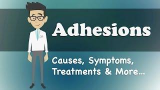 Adhesions - Causes, Symptoms, Treatments & More…