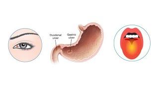 FACE AND TONGUE DIAGNOSIS OF GASTRIC AND DUODENAL ULCERS (PEPTIC ULCERS)