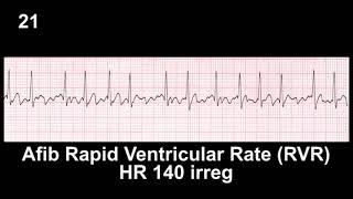 ECG Rhythm Recognition Practice - Test 1