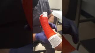 How to Apply a Short Arm Fiberglass Cast