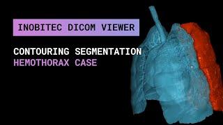 Сontouring Segmentation in Inobitec DICOM Viewer Pro: Hemothorax Сase