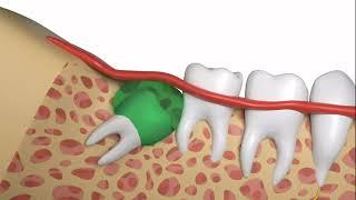 How To Safely and Quickly Have a Wisdom Tooth Extraction